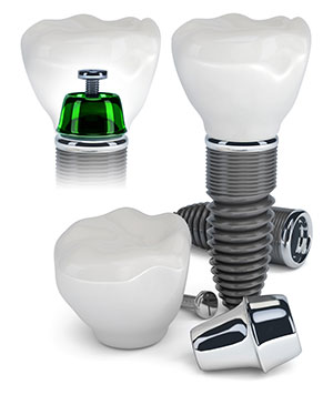 Dental Implants Baltimore
