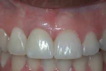 Dental Implants Pikesville