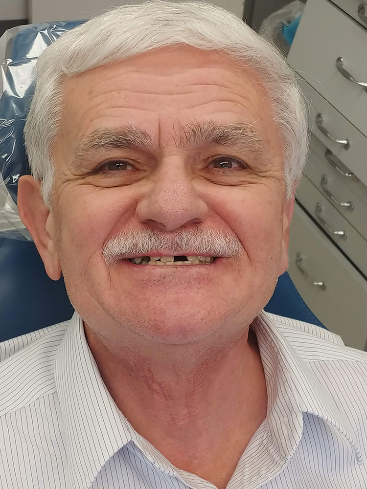 Same Day Dental Implants in Pikesville